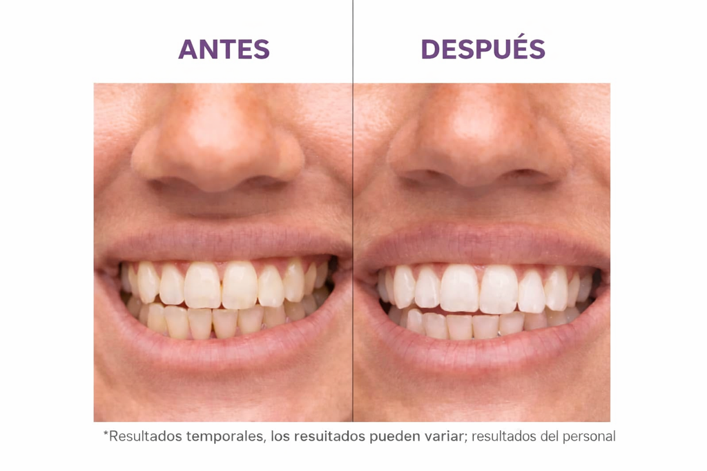 Tiras Blanqueadoras Dentales V34 de Hismile