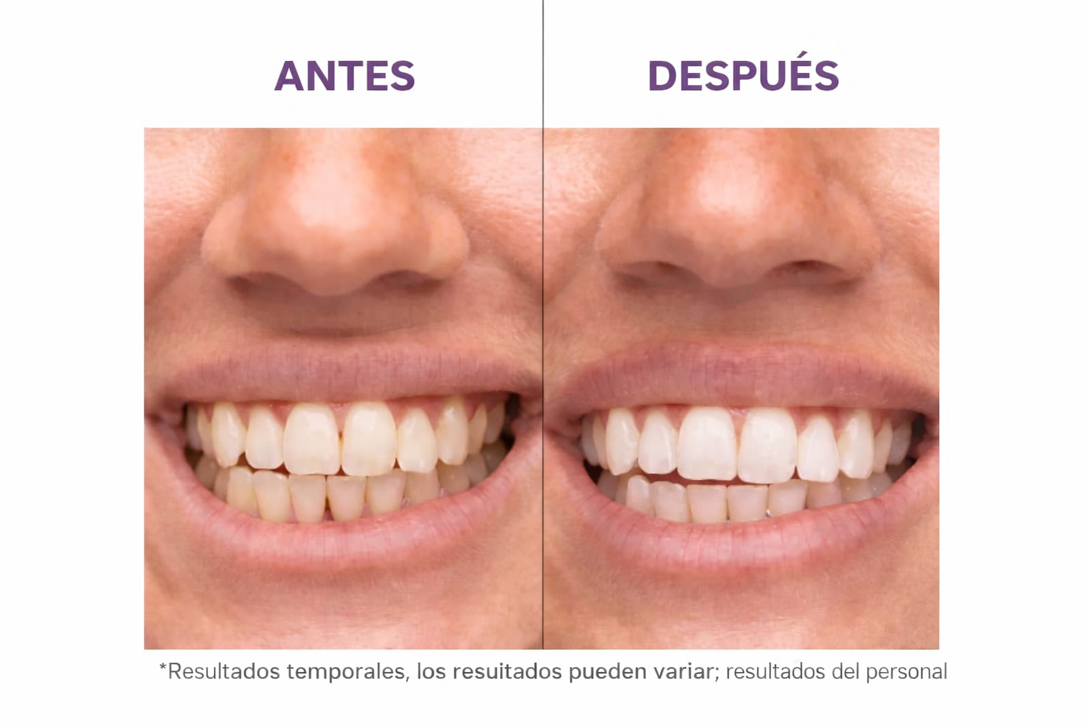 Tiras Blanqueadoras Dentales V34 de Hismile